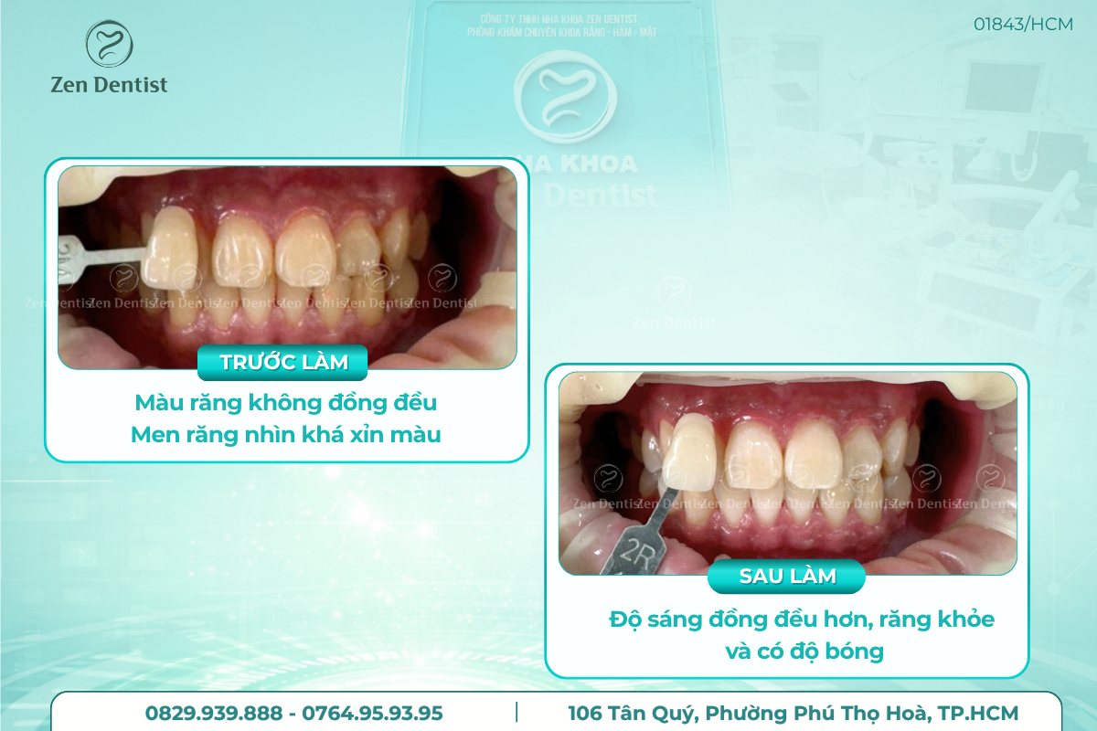 Làm thế nào để duy trì hàm răng trắng sáng lâu hơn sau khi tẩy trắng?