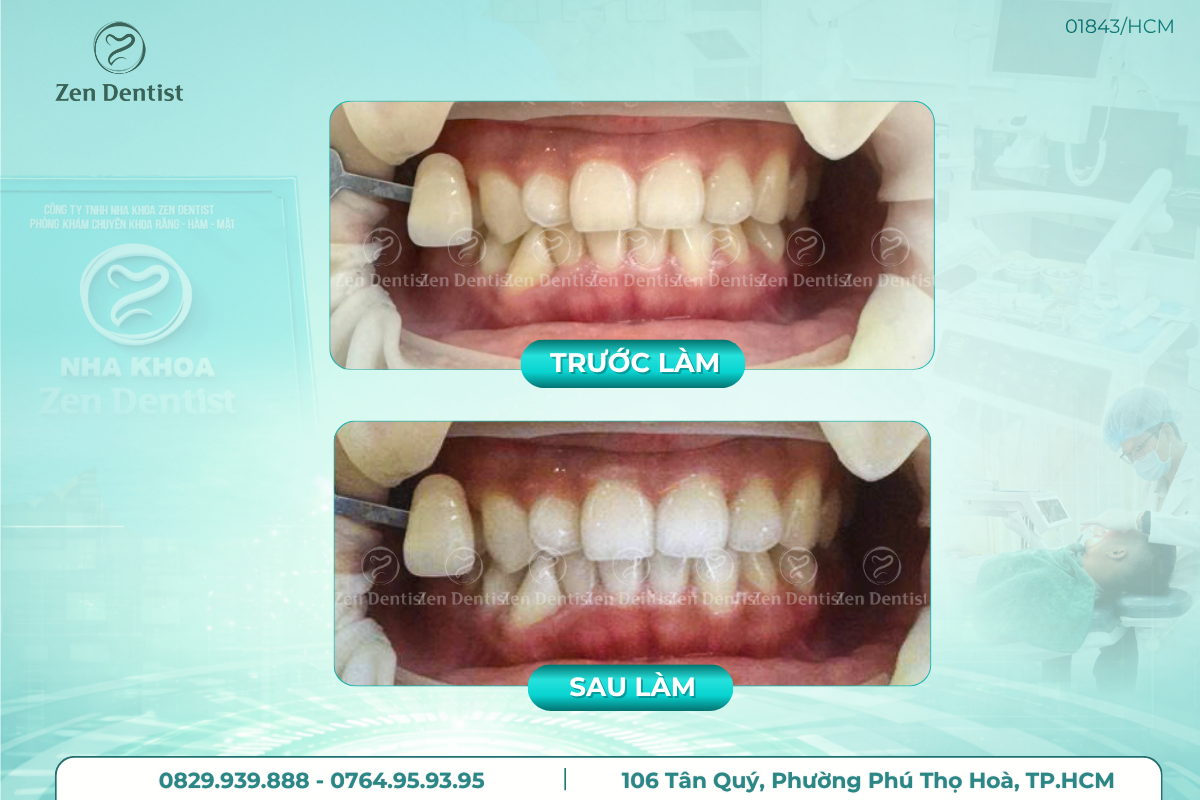 Vì sao nhiều người lựa chọn tẩy trắng răng?