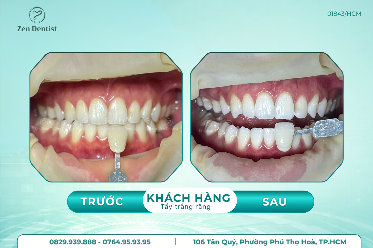 Tẩy trắng răng không gây ê buốt