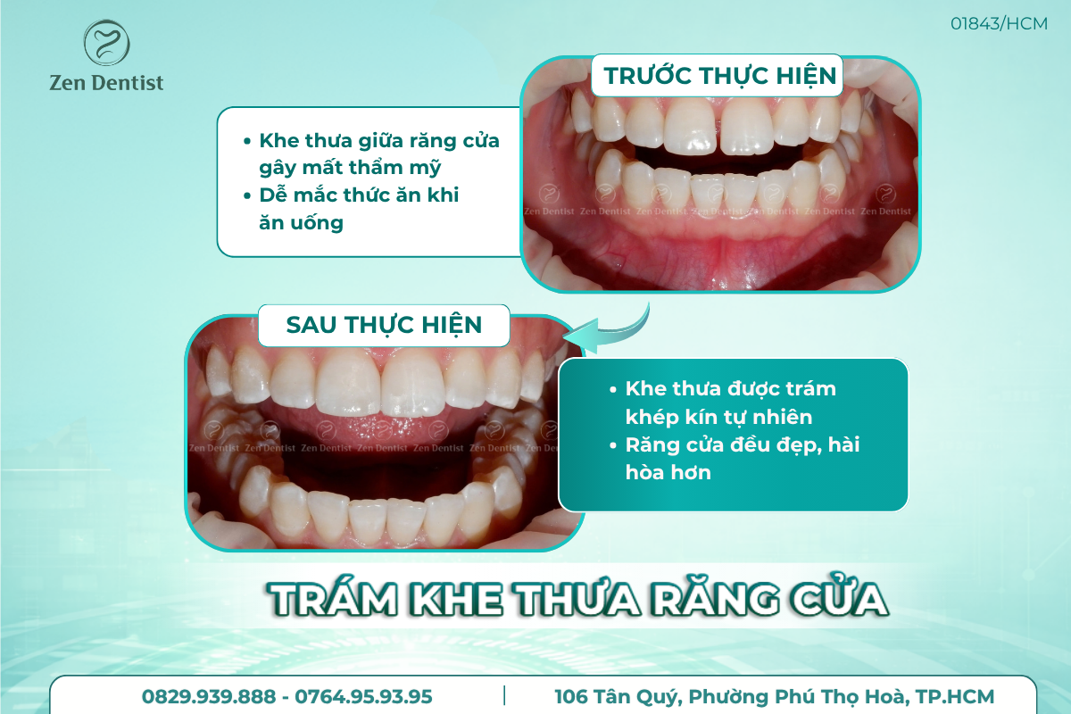 Khám răng định kỳ 