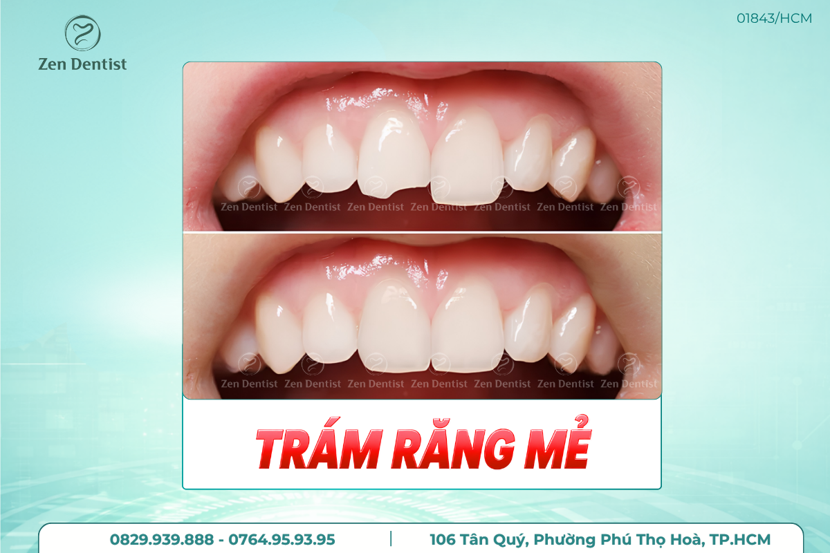 Làm thế nào để kéo dài tuổi thọ của miếng trám?