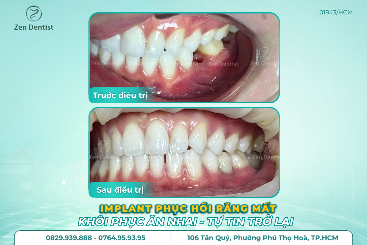 Zen Dentist địa chỉ uy tín khi trồng răng implant Tân Phú giá rẻ