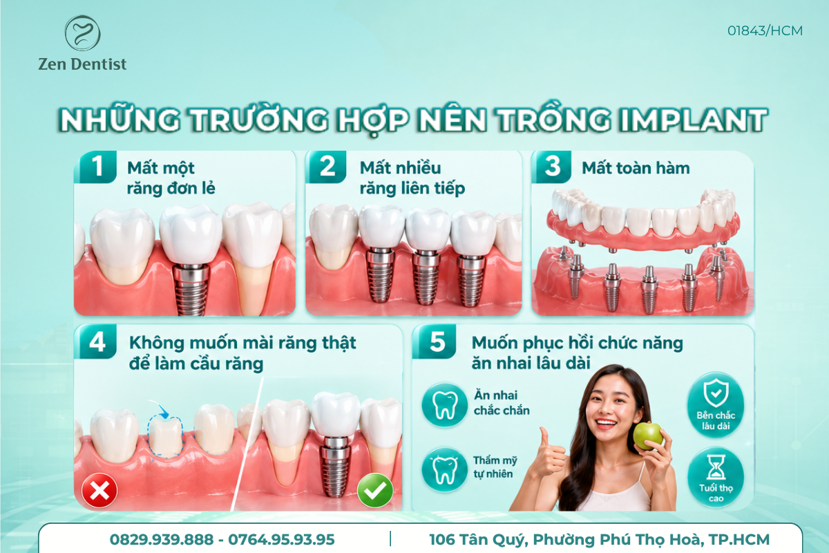 Những trường hợp nên trồng răng Implant