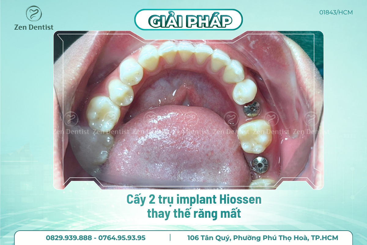 Trồng răng implant Tân Phú giá rẻ