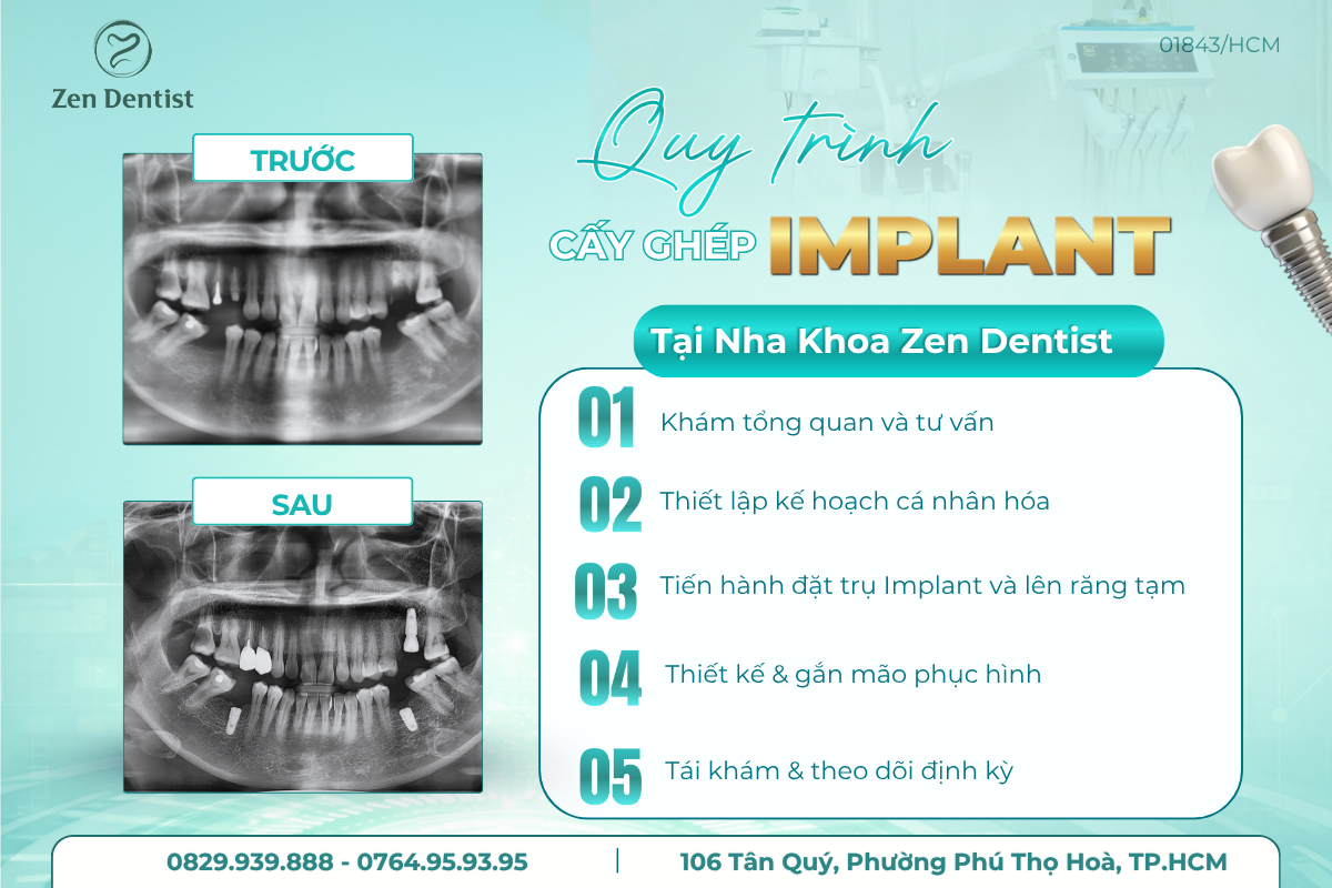 Quy trình trồng răng Implant tại Zen Dentist