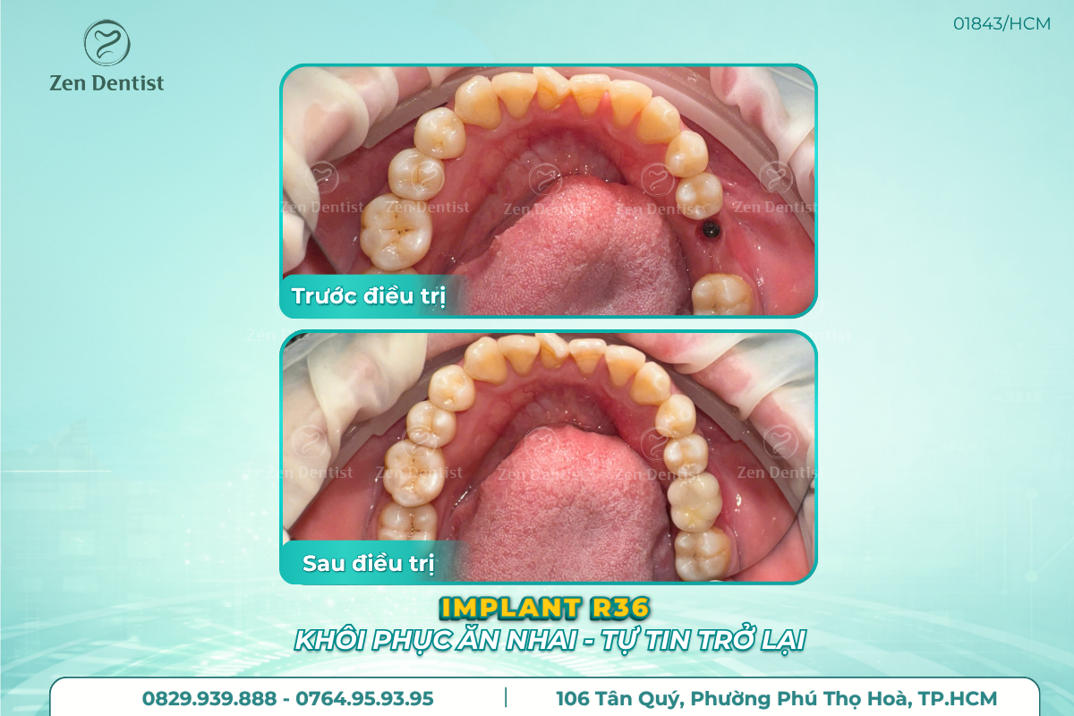 Bao nhiêu tuổi thì trồng răng implant được?