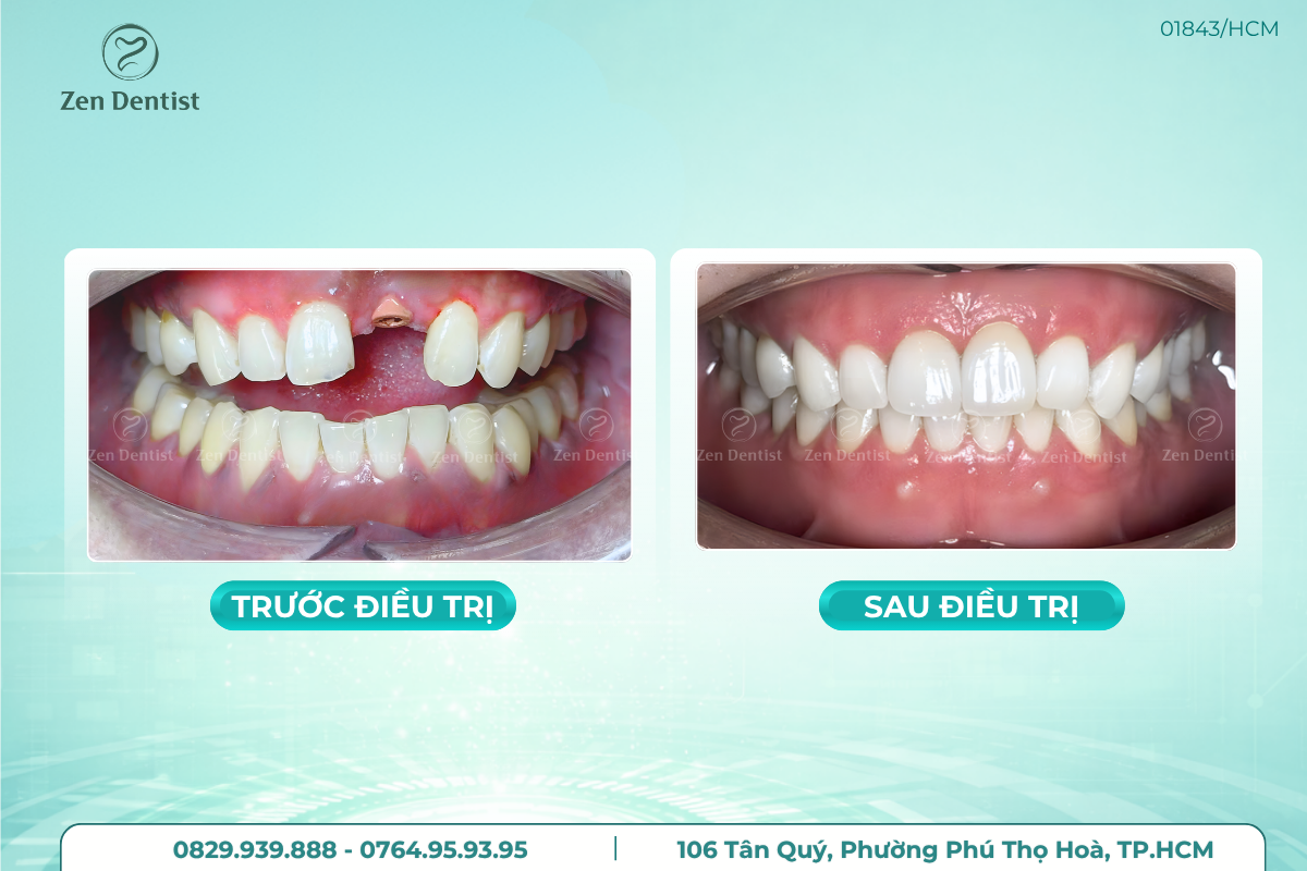 Trồng răng implant uy tín tại Zen Dentist