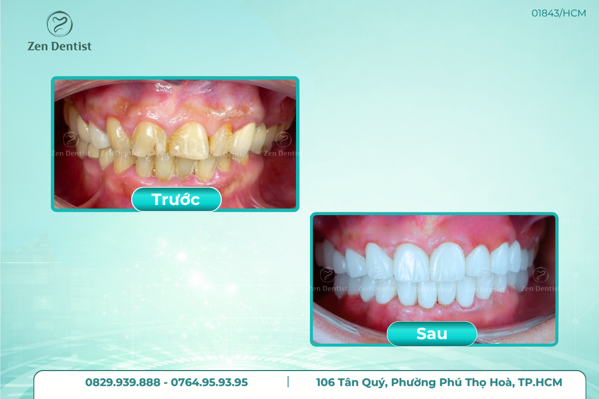 Bọc răng sứ đẹp an toàn uy tín tại Zen Dentist