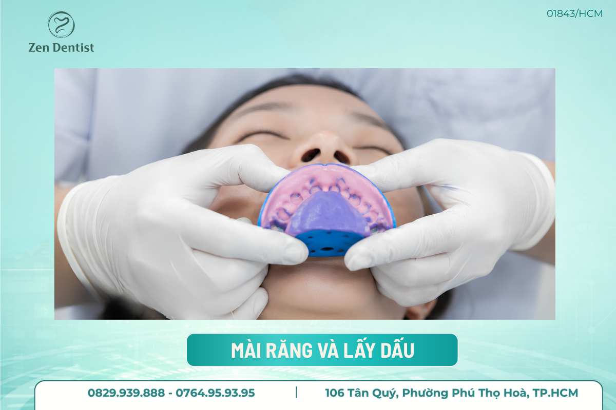 Nguyên nhân bọc răng sứ bị đau chân răng