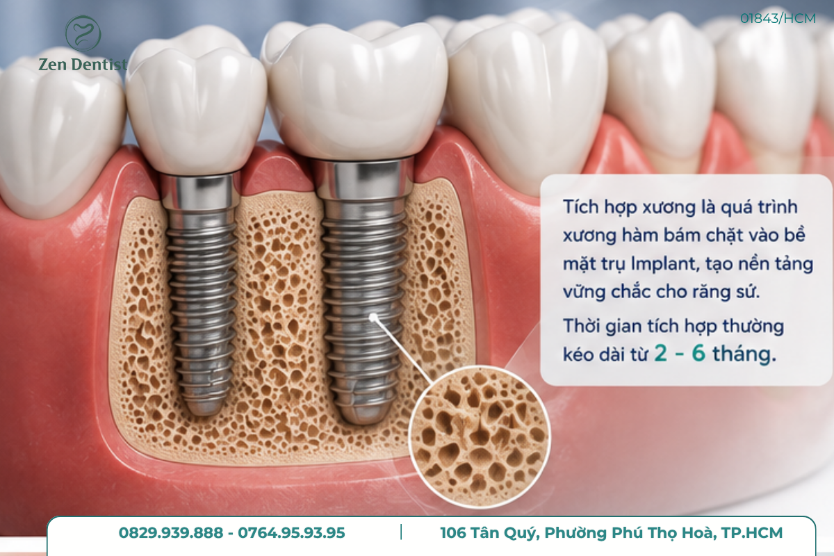 Vị trí cấy ghép Implant