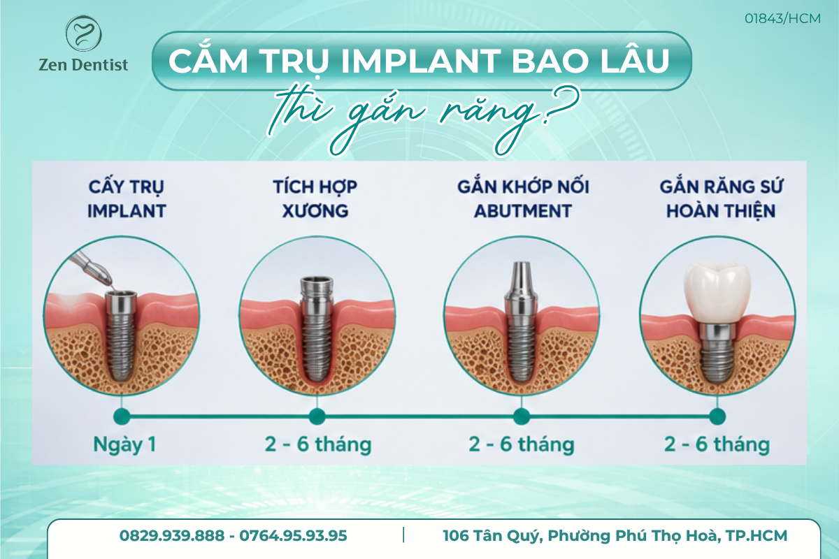 Cấy trụ Implant bao lâu thì gắn răng được?