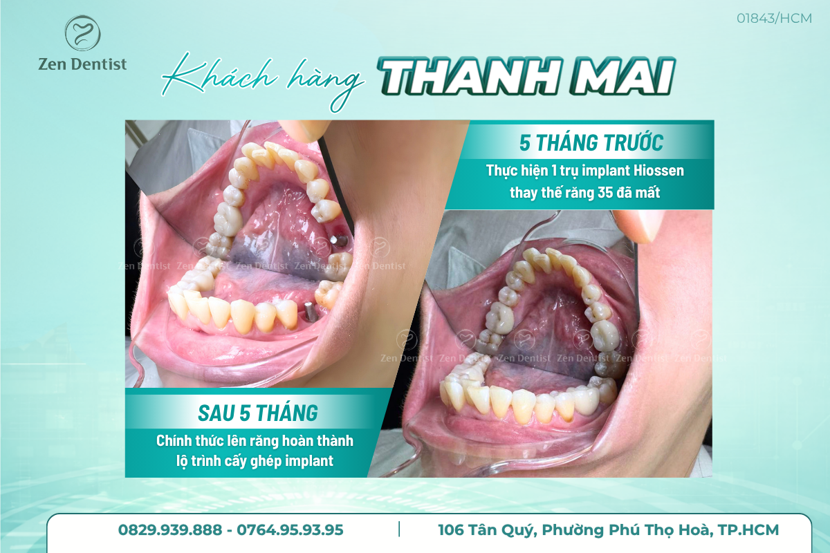 Khách hàng trồng răng implant tại Zen Dentist