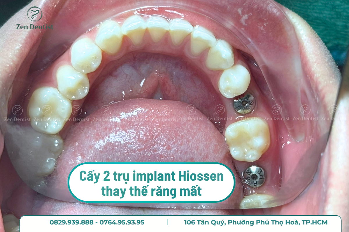 Cấy 2 trụ implant Hiossen thay thế răng mất