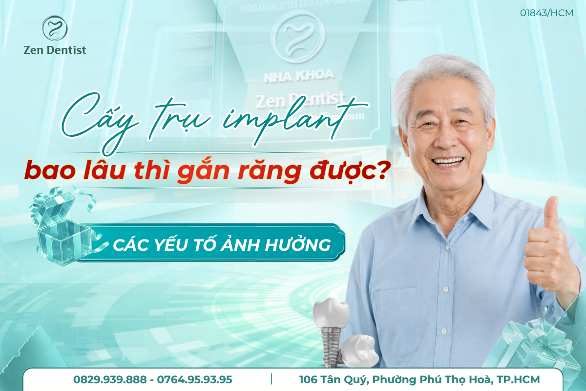 cấy trụ implant bao lâu thì gắn răng