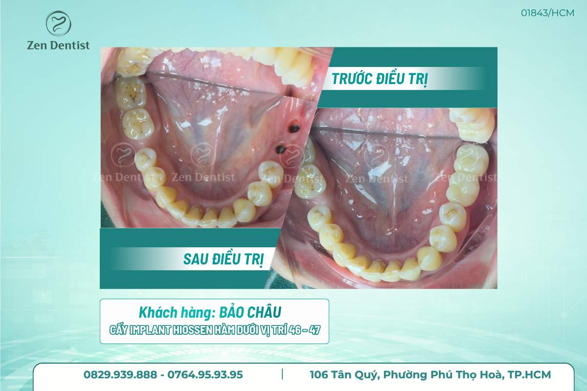 Vị trí răng mất