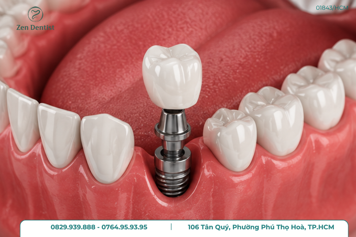 Implant cho răng mất răng lâu năm