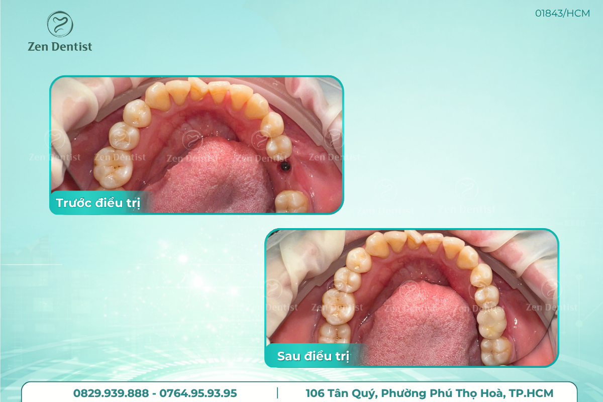 Kinh nghiệm lựa chọn implant phù hợp
