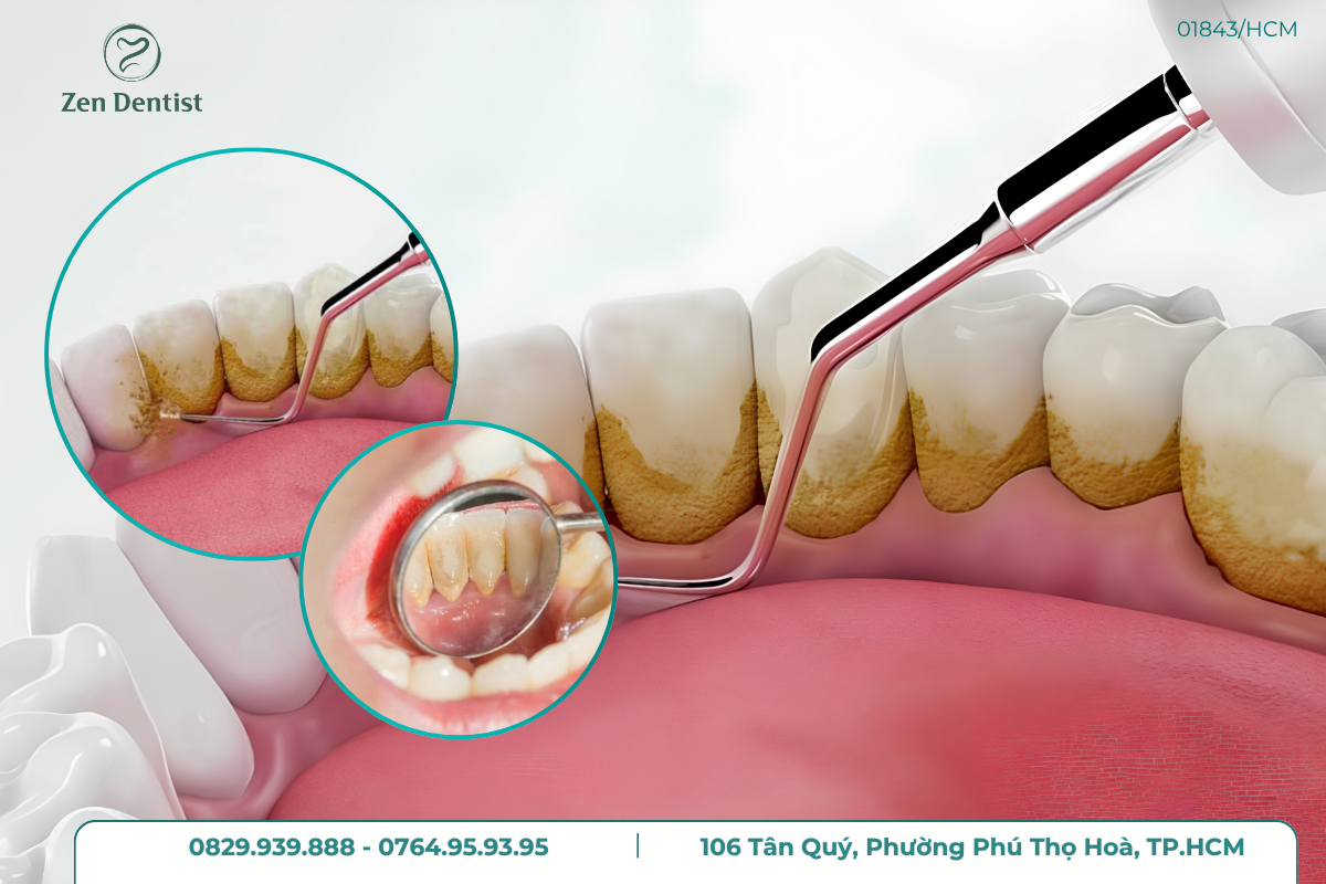 Lấy cao răng xong nên kiêng gì trong ăn uống?