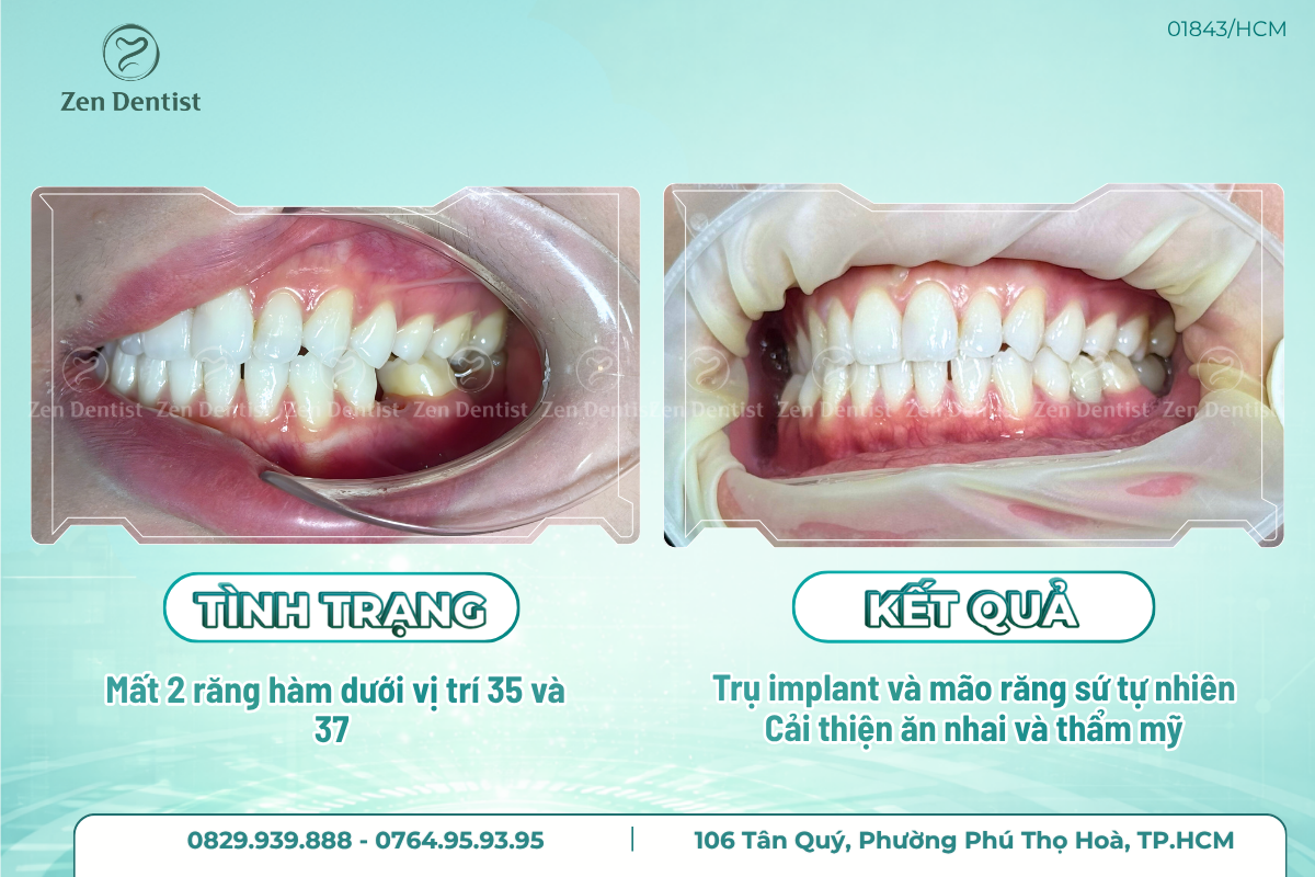 Trồng răng implant tại Zen Dentist
