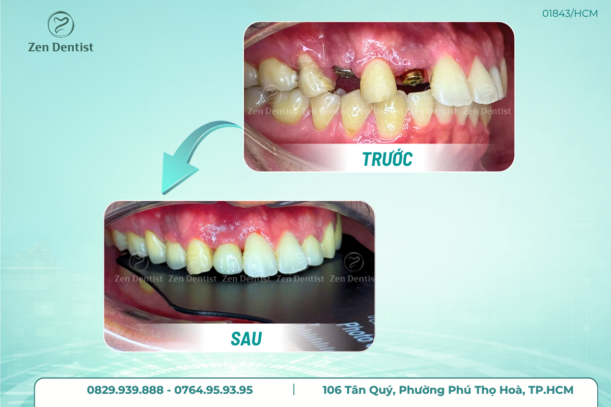 Trụ Implant Hiossen