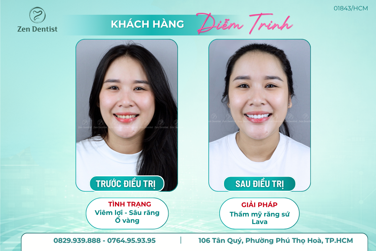 Vì sao nhu cầu tìm nha khoa bọc sứ tại Tân Phú ngày càng tăng?