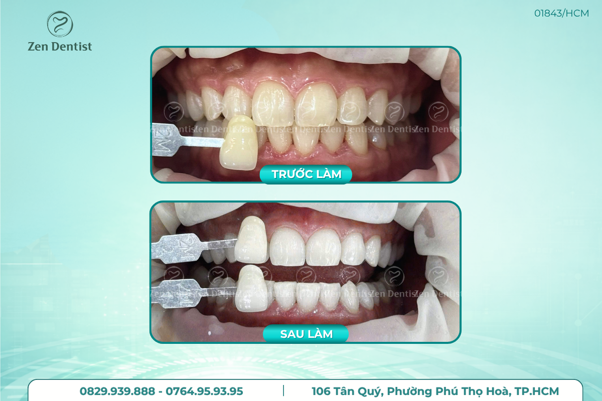 Vì sao nhiều người tìm kiếm nha khoa tẩy trắng răng gần đây?