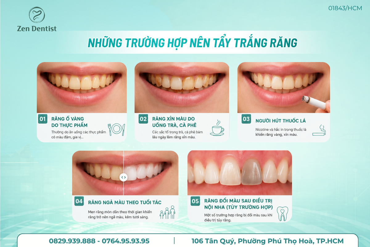 Những trường hợp nên tẩy trắng răng