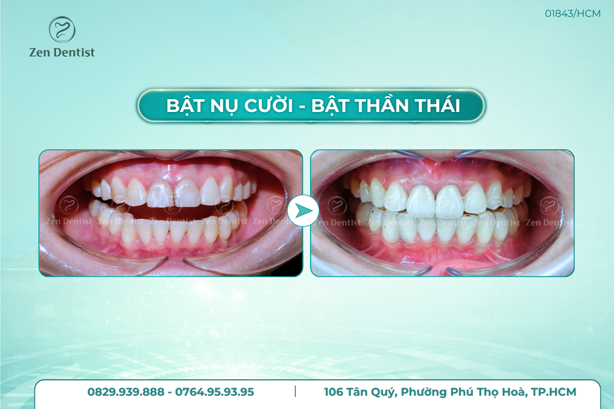 Làm răng sứ đẹp an toàn tại Zen Dentist