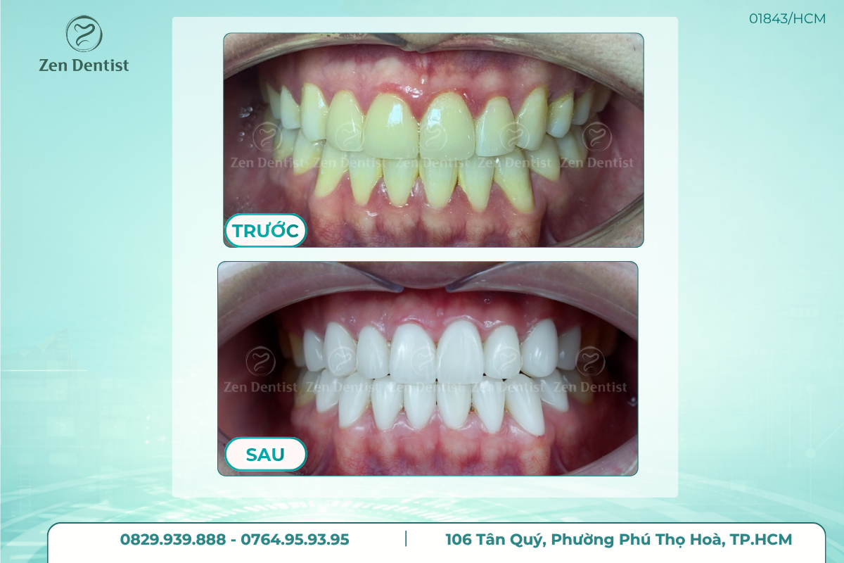 Độ bền của răng sứ phụ thuộc vào những yếu tố nào?