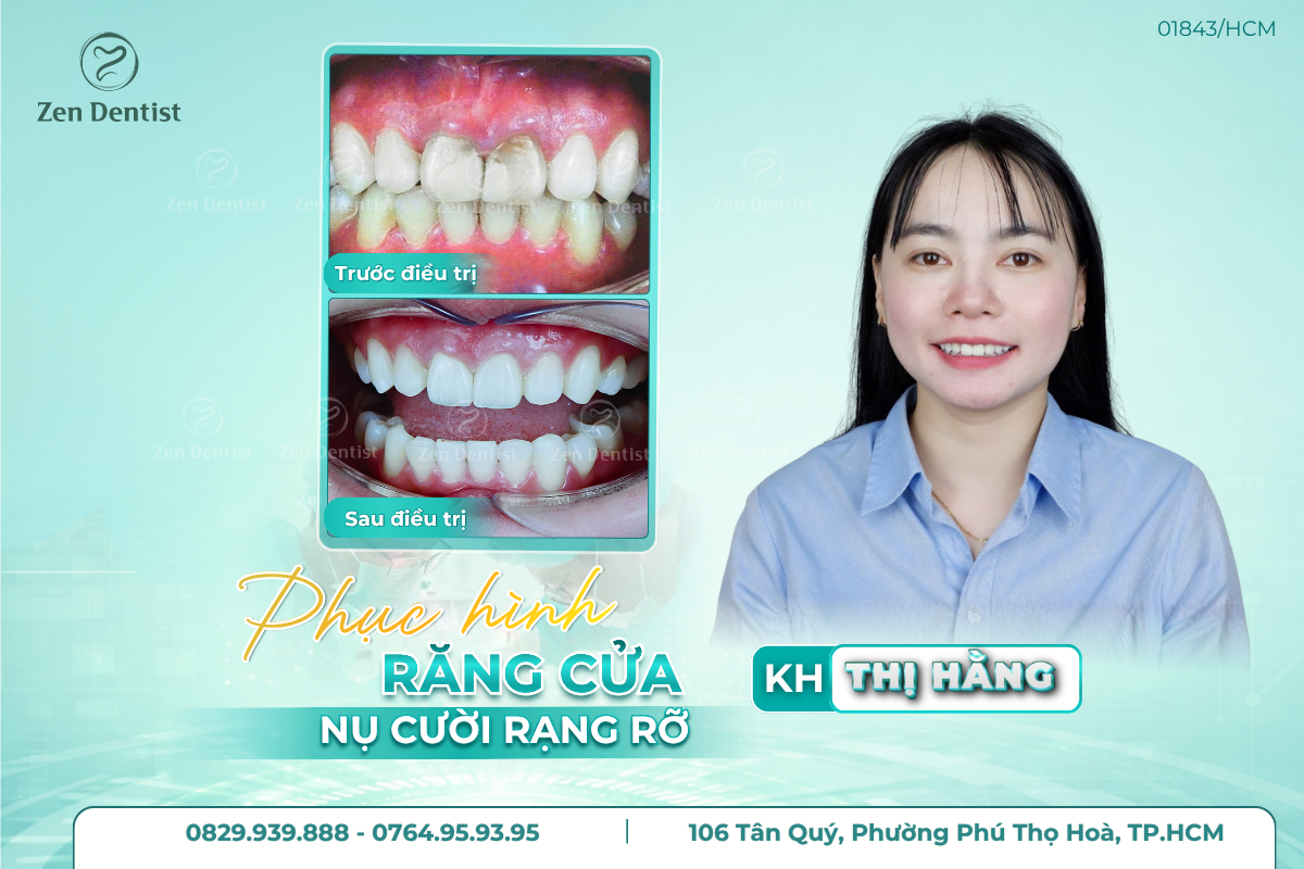 Phục hình răng cửa với răng sứ toàn sứ