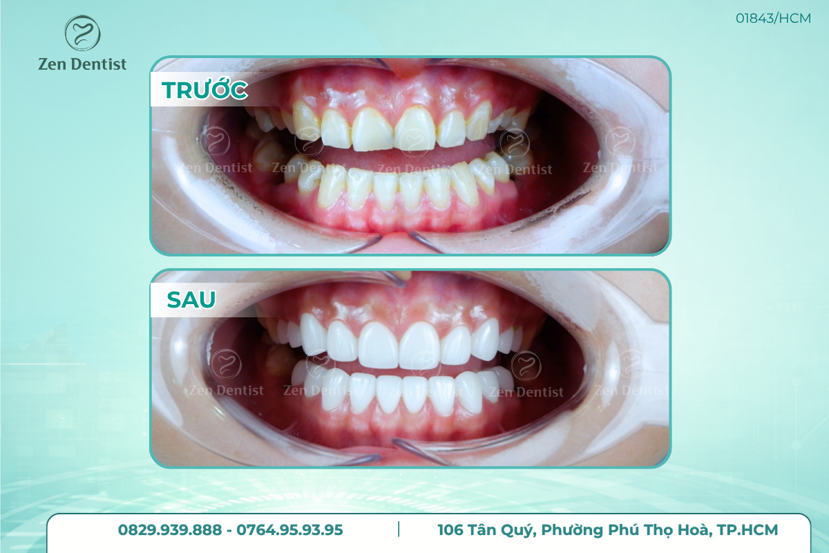 Làm răng sứ uy tín tại Zen Dentist