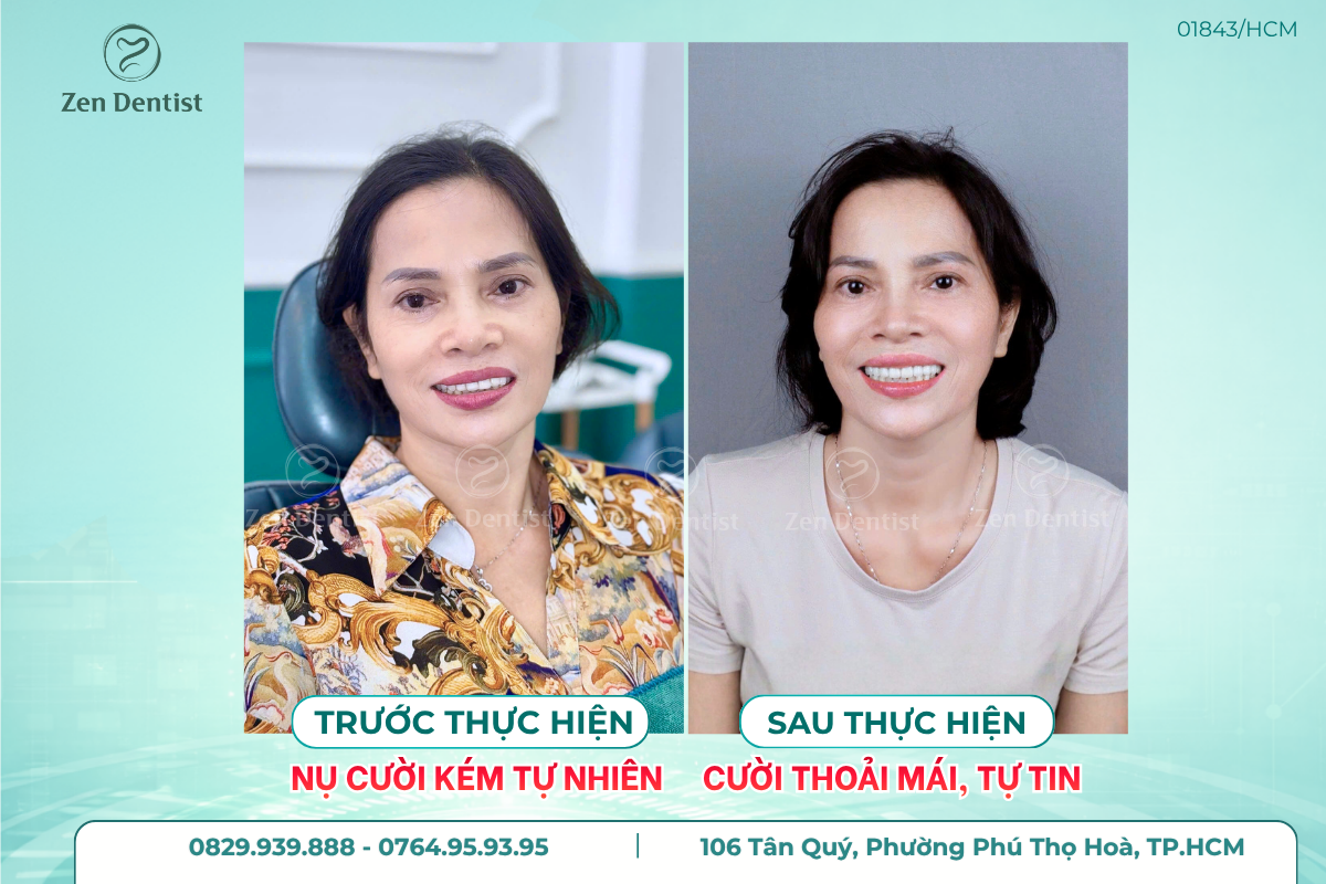 Răng sứ Zirconia có tốt không?