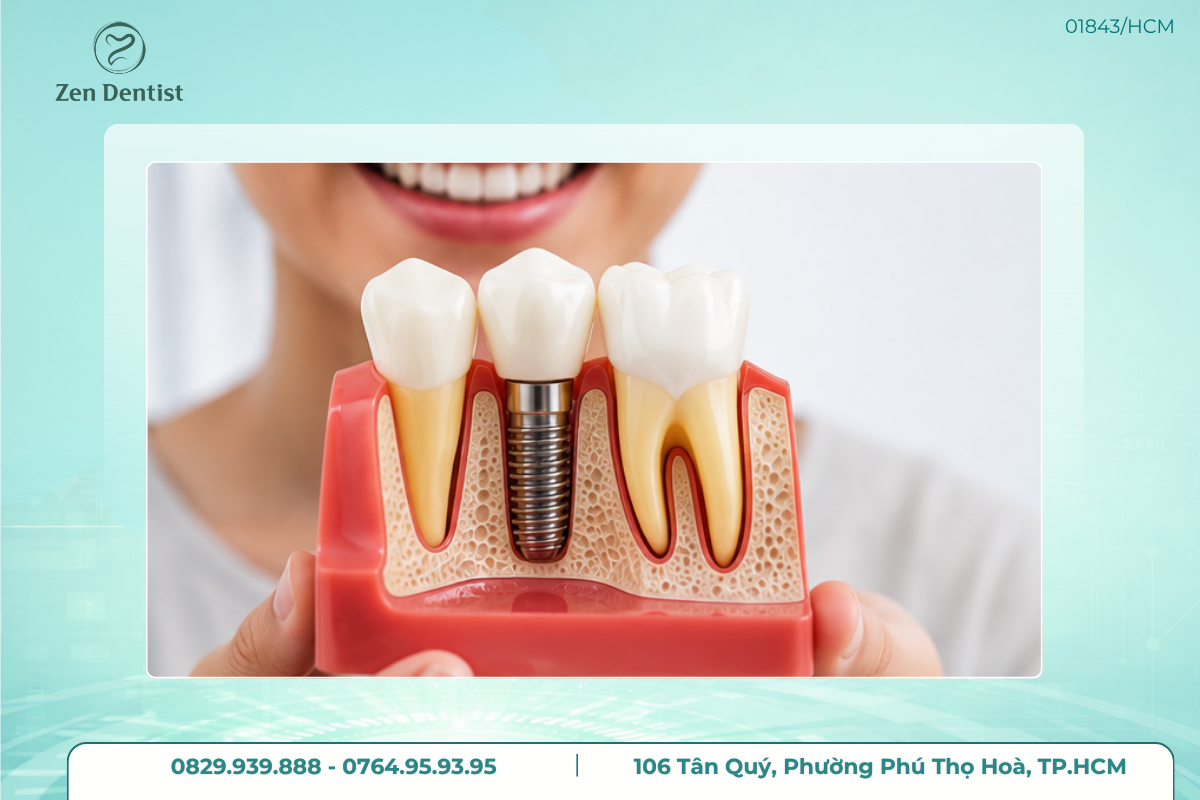 Vì sao không thể gắn răng sứ ngay sau khi cấy Implant?