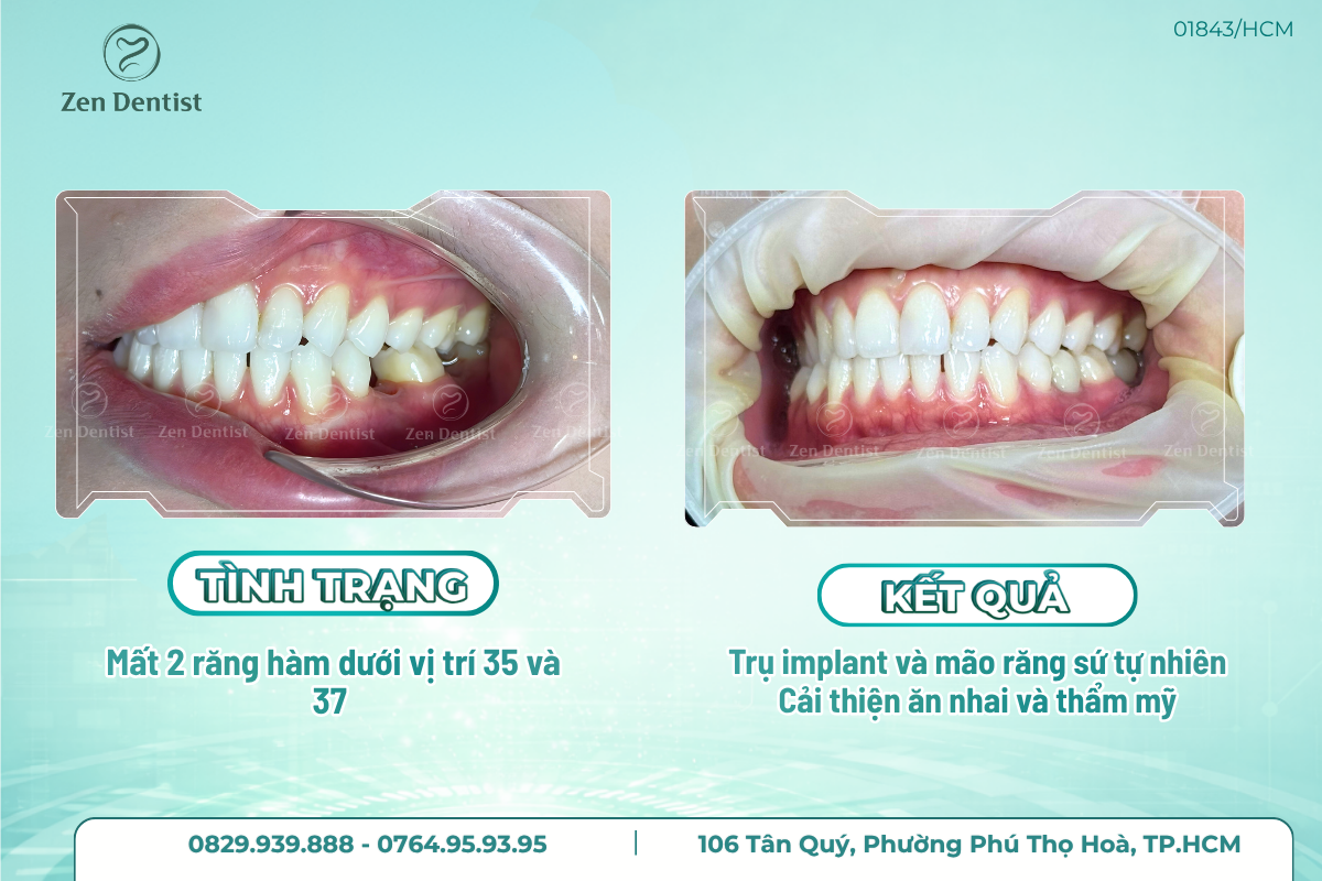 Sau khi cấy Implant bao lâu thì làm răng sứ?