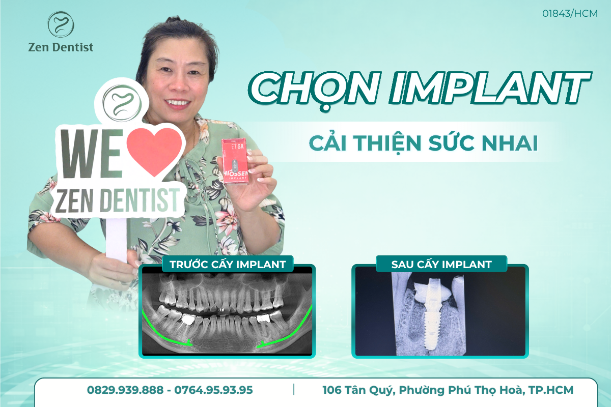 Dấu hiệu Implant đã đủ điều kiện để gắn răng sứ