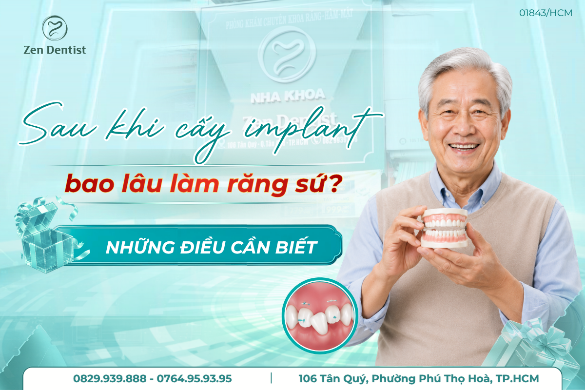sau khi cấy Implant bao lâu thì làm răng sứ