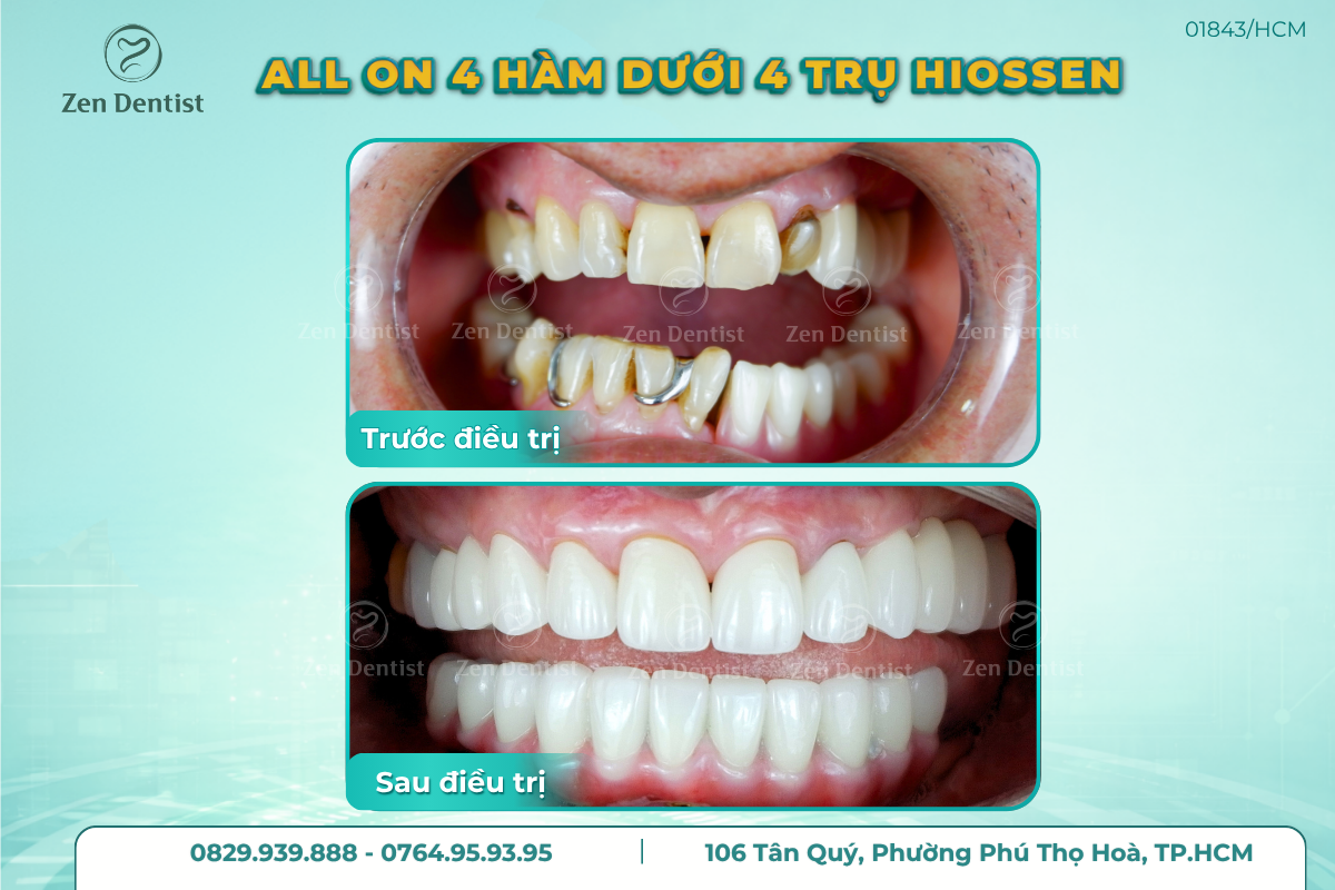 Vì sao cần so sánh các dòng Implant trước khi lựa chọn?
