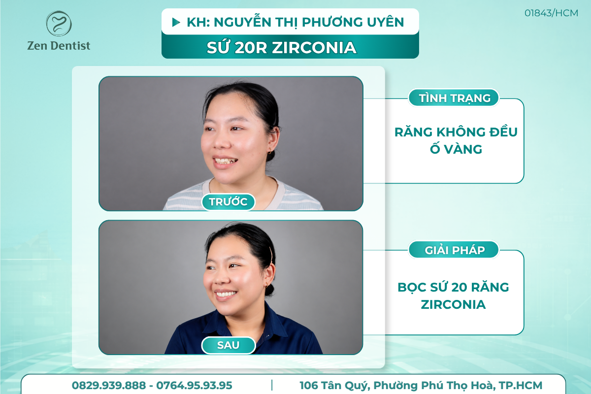 Răng sứ Zirconia