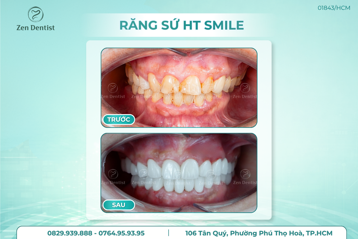 Răng sứ HT Smile
