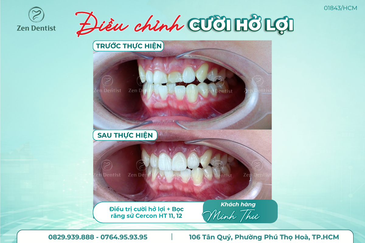 Răng sứ Cercon HT