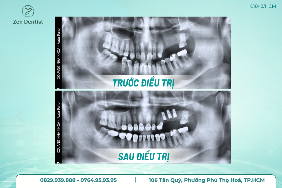 Trụ Implant Biotem
