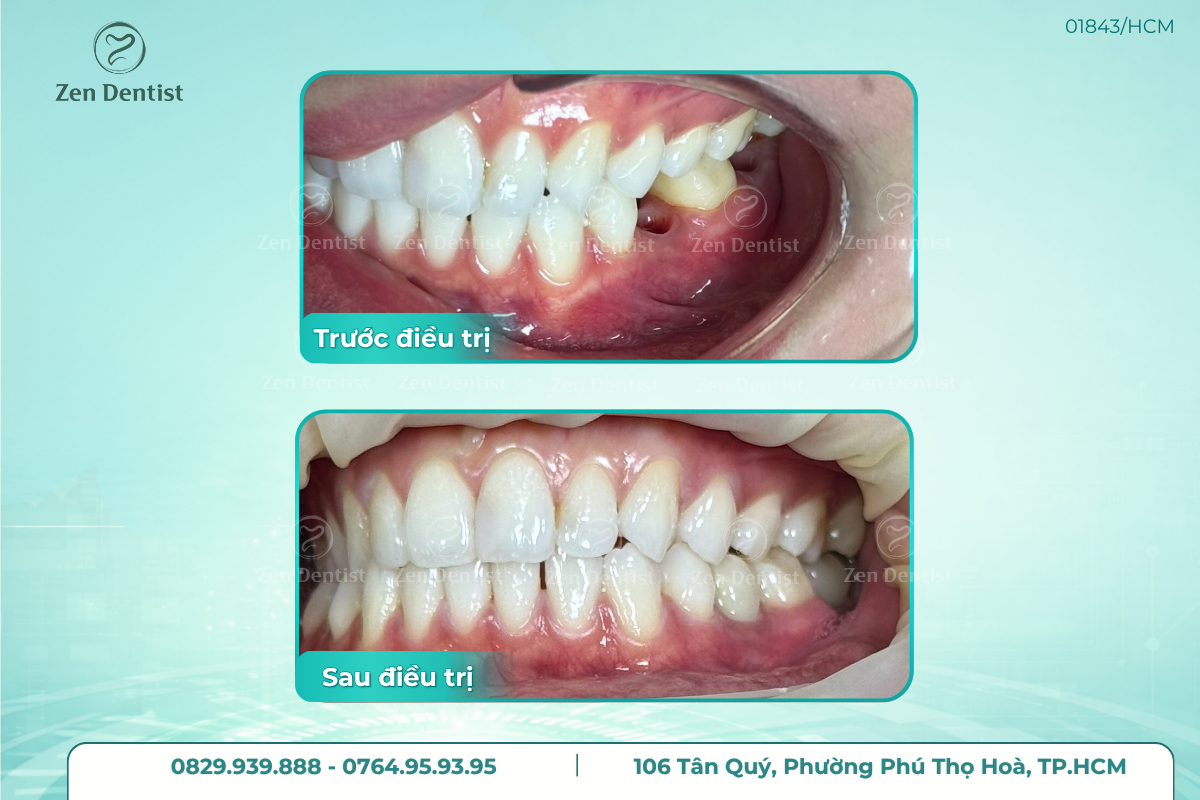 Zen Dentist - Địa chỉ trồng răng Implant uy tín an toàn