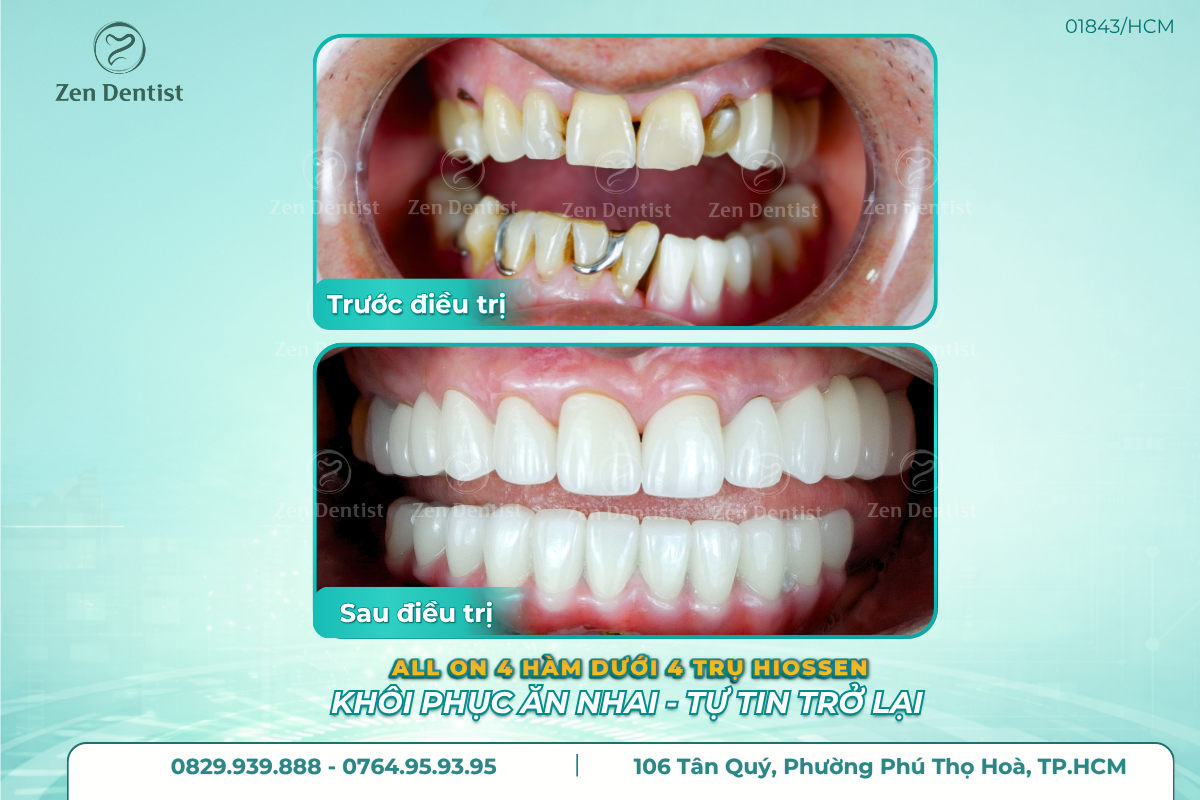 Tìm hiểu các loại trụ implant phổ biến