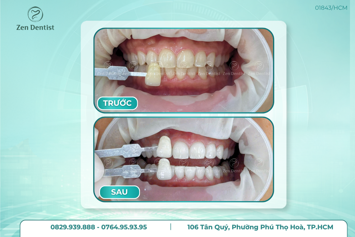 Tẩy trắng răng an toàn hiệu quả tại Zen Dentist