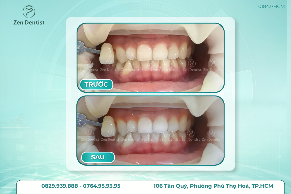 Tẩy trắng răng không đều màu có tự hết không?