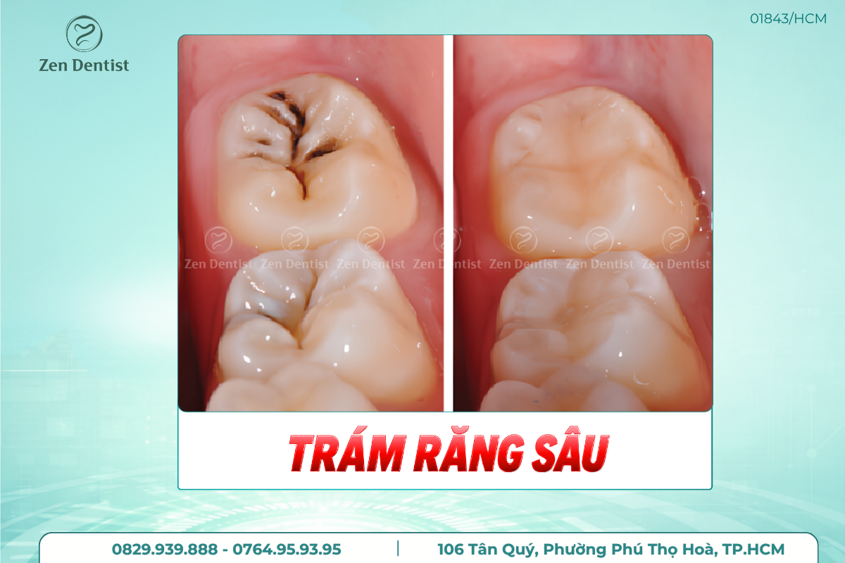Trám răng sâu có bền không?