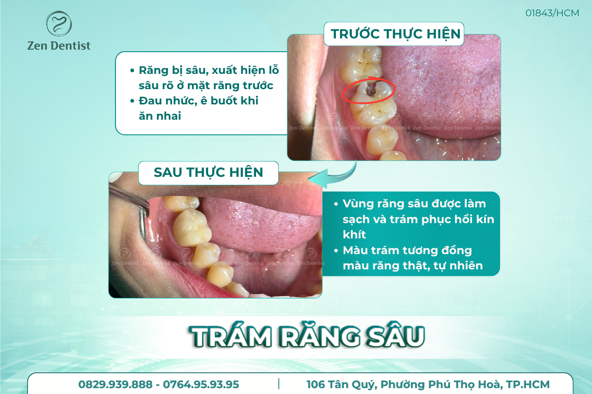 Chất liệu trám được sử dụng