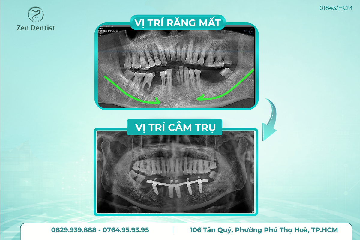 Phương pháp trồng răng Implant