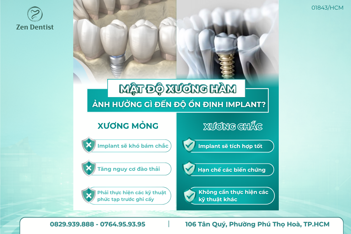Chất lượng và mật độ xương hàm.