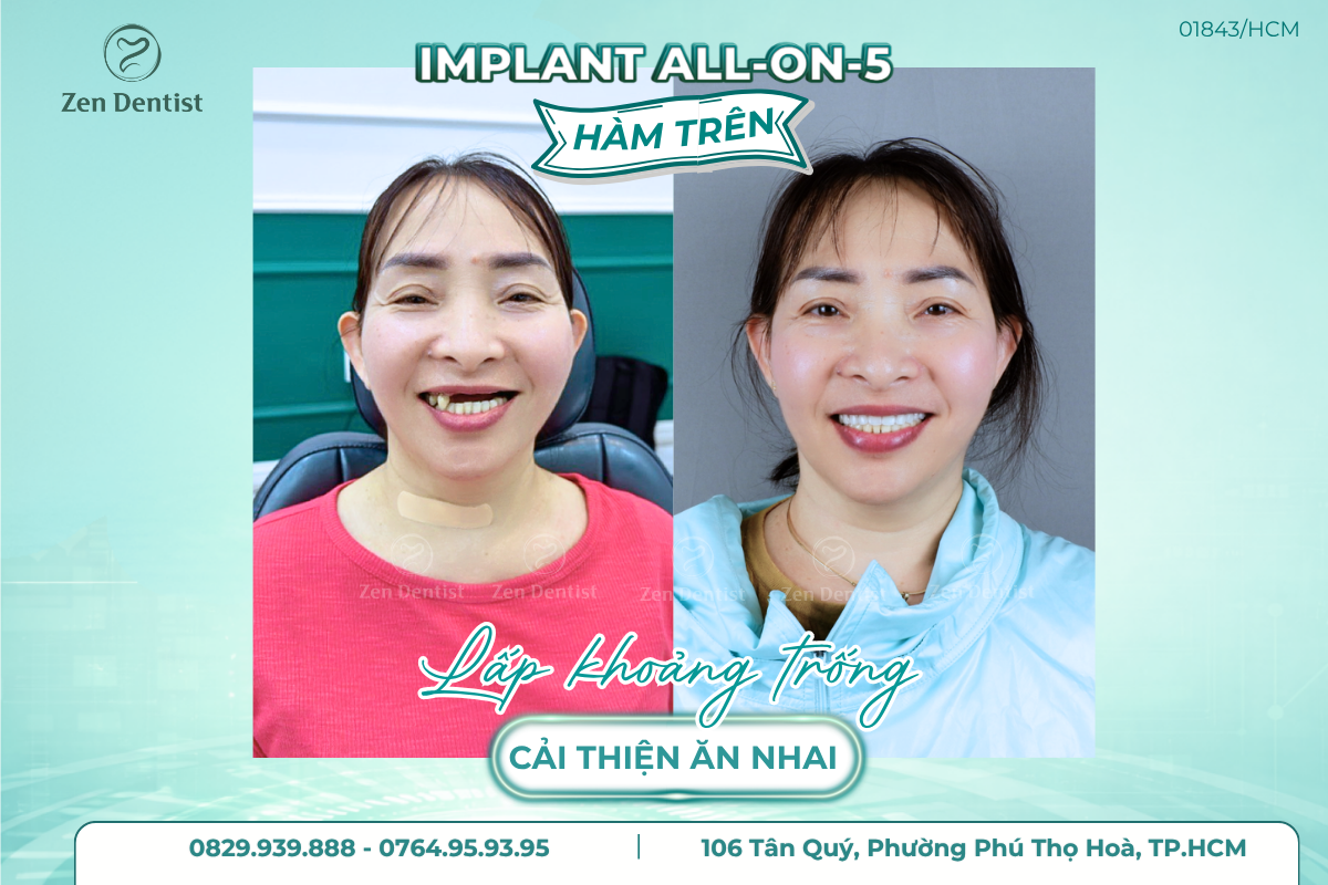Vì sao trồng Implant được đánh giá là an toàn?